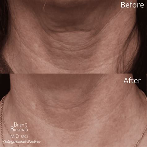 How Does Using Hyper Dilute Radiesse Enhance Utherapy .